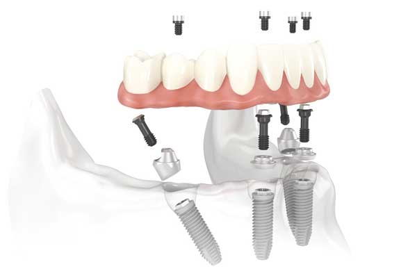 Impianti dentali ad Alzate Brianza | Implantologia