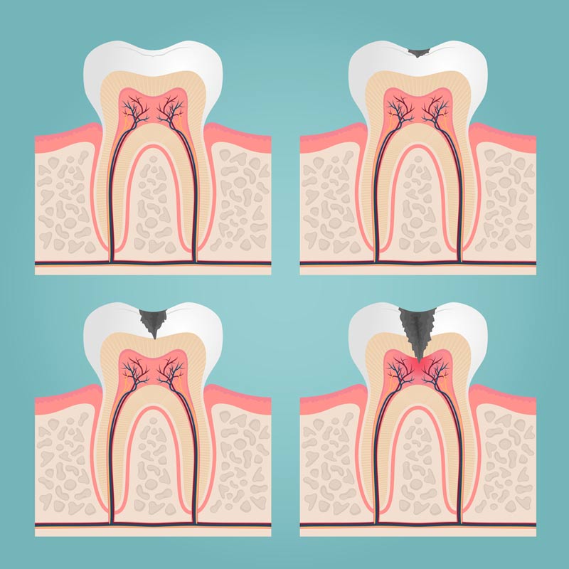 endodonzia allo studio dentistico riva